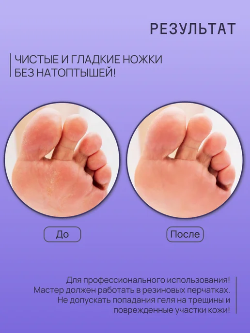 Sagitta professional Гель для удаления мозолей и натоптышей, вариант, фото 4