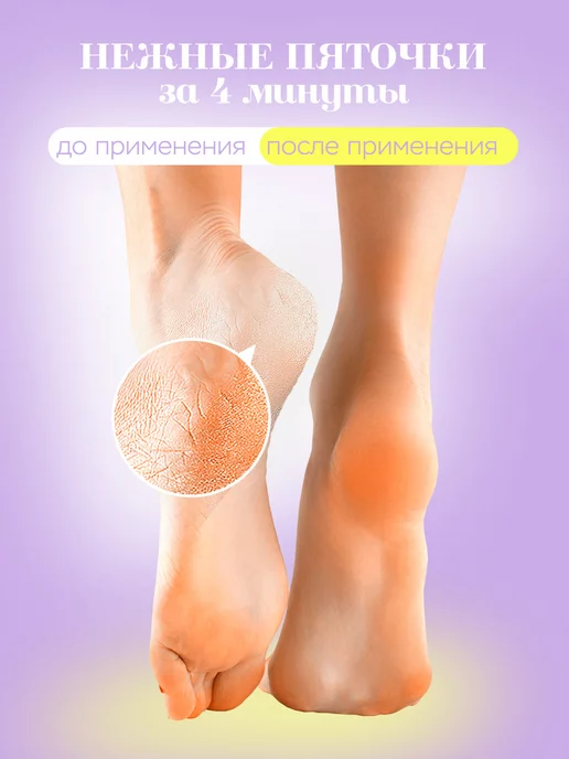 Нежные Пяточки Педикюрный набор кератолитик уход за кожей ног, вариант, фото 3