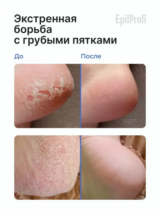 EpilProfi Кератолитик для пяток с мочевиной от трещин, для педикюра, 2 шт, фото 2