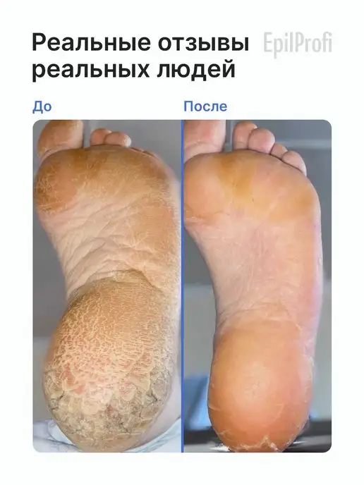 EpilProfi Кератолитик для пяток с мочевиной от трещин, для педикюра, 2 шт, фото 6