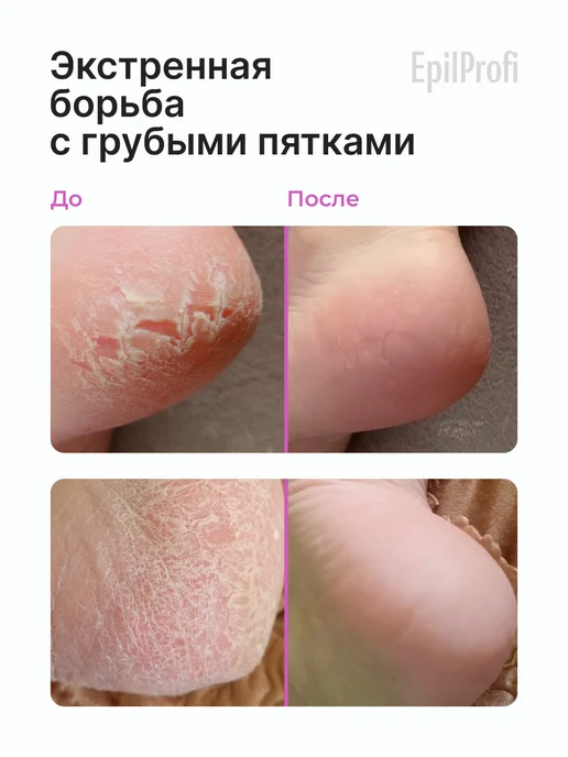 EpilProfi Кератолитик для пяток с мочевиной от трещин, для педикюра, вариант, фото 2
