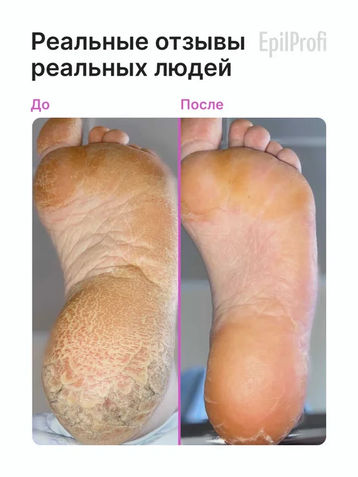 EpilProfi Кератолитик для пяток с мочевиной от трещин, для педикюра, вариант, фото 6