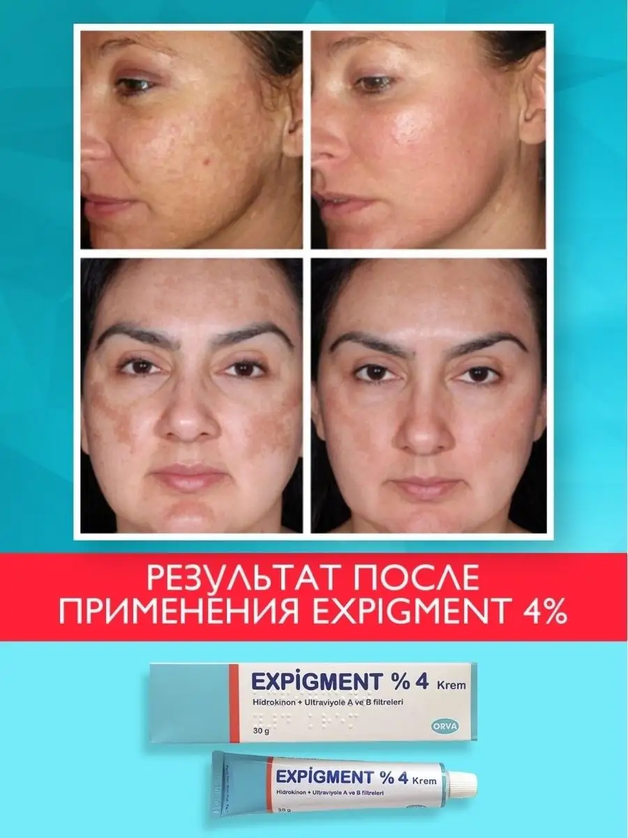 Отбеливающий крем для лица Expigment 4% гидрохинон ORVA 42769159 купить за  464 ₽ в интернет-магазине Wildberries